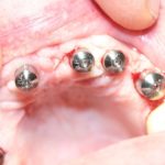 Zubni implantati odlično su rješenje kod nedostatka zuba